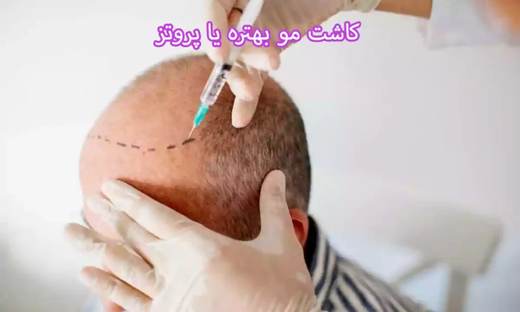 کاشت مو بهتره یا پروتز
